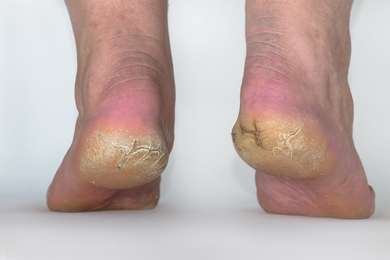 What May Be Causing Your Cracked Heels